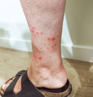 ������ ��å�� ��, �ٸ��� ��ߺұ� ������ ������ "�� �̷� ��..