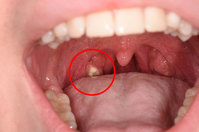 이 닦아도 풍기는 냄새, 편도에 박힌 ‘노란 알갱이’가 원인… 없애..