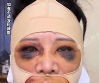 “예뻐지려 ‘이것’ 받았다가, 판다됐다”… 끔찍 부작용 겪은 50대 ..