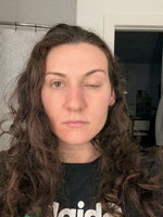 편두통 고치려 ‘이 치료’ 받았다가… 한쪽 눈 못 뜨게 된 여성, 무..