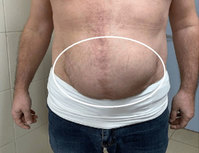 “뱃살 아니에요”… 60대 男, 배 ‘불룩’ 튀어나온 예상치 못한 원..