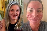 “실리프팅 잘못 받으면 안 되겠네” 얼굴에 구멍 생긴 英 여성… 어..