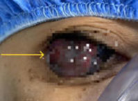 “눈의 점, 점점 커지더니”… 30대 여성, 공격적인 ‘이 병’으로 드..