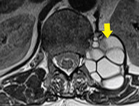 “허리 아파 사진 찍었더니, 웬 포도알 덩어리…” 50대 男, 기생충 ..