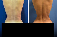 “이 수술 진짜 한다고?” 갈비뼈 이동시켜 ‘모래시계’ 체형으로… ..