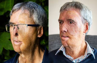 음주 운전 사고로 얼굴 절반 잃은 남성… “3D 프린팅으로 새 삶 시작..