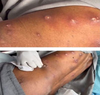 여행 다녀온 뒤 피부 아래 ‘꿈틀꿈틀’… 알고 보니 파리 유충?