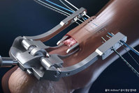 SNU���ﺴ�� ����������, ��ų������ �Ŀ� ���� ��3cm�������� ��..