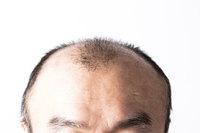 탈모 약, ‘효과 센 약’이 다가 아니다