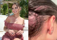 “객혈하고 머리카락 빠져”… ‘살인 곰팡이’ 감염된 30대 女, 무슨 사연?