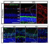망막 변화 통해 파킨슨병 조기 진단 단서 규명