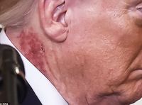 트럼프 목에 나타난 붉은 자국, 전문가는 ‘이렇게’ 봤다