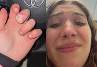 흔한 ‘이 행동’ 탓, 손가락 절단 위기 처한 20대 女… 대체 무슨 일?