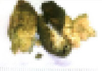 “돌처럼 굳었다”… 60대 男, 위장에 꽉 찬 저게 대체 뭐야?