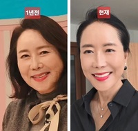 64세 윤영미, 안면거상술 받고 달라진 외모… 모습 보니?