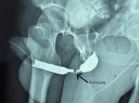 “갑자기 소변이 안 나와” 30대 男, ‘이 일’ 겪은 뒤 요도 협착… 무슨 사연?