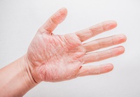 “손 때문에 직업도 포기”… 만성 손습진, 중증인데 치료·보험은 모..