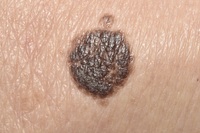 나이 들어 얼굴에 생긴 ‘이것’, 잡티 아닌 종양이었다