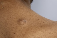 목에서 만져지는 작은 혹… 암일까?