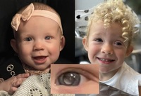 “눈곱이라더니” 아기 눈 속 흰색 빛, 희귀 안암 신호였다