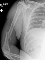 팔씨름하다가 봉변… 25세 男 입은 부상 “아찔”