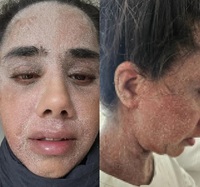 흔한 ‘이 연고’ 발랐을 뿐인데… ‘코끼리 피부’ 된 30대 女