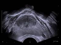 [의학칼럼]​크기가 작아도 소변은 막힌다…전립선비대증도 ‘관상’을 봐야 하는 이유