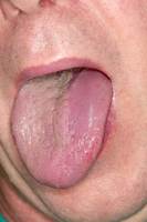 지나치게 붉은 혀는 ‘감염’ 탓… 노랗게 변했다면?