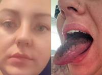 “썩은 달걀 냄새가”… 비만 주사 맞고 담낭까지 제거한 30대 女, 무슨 일?