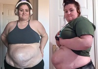 수술 합병증으로 ‘거대 탈장’ 안고 살아가는 英 여성… 무슨 사연?