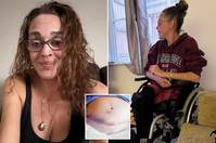 제왕절개 후 ‘살 파먹는 병’ 걸린 40대… 수술 도구 탓이라던데?