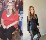 “출산 후 살 아니라 병이었다”… 여성 10명 중 1명 ‘지방부종’