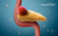 췌장암 항암제 내성 차단하는 새 치료법 제시