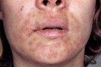 얼굴에 난 뾰루지, 매독 신호였다… 다른 증상은?
