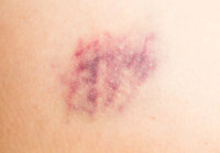 이유 없이 생긴 멍… “코피·잇몸 출혈 동반된다면 혈액암 검사 필요”