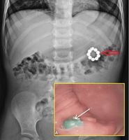 ‘이 장난감’ 삼켰다가 장 뚫린 남아… 대체 뭐였나?