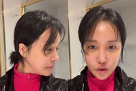 랄랄 ‘눈밑 지방 재배치’ 후기 들어보니… “전보다 ‘이 증상’ 심해졌다”