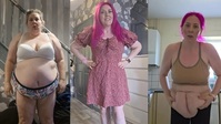 63kg 감량했더니… ‘뜻밖의 부작용’ 겪은 여성, 무슨 일?