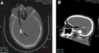 “볼펜이 안구 뚫고 뇌까지 찔러” 60대 男, 대체 어쩌다가?