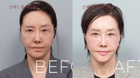 ‘61세’ 유혜리, 달라진 외모 공개… ‘이 시술’ 후 “매우 만족”