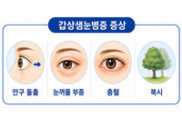 갑상선 질환자 ‘눈 건강’도 살펴야… 눈 튀어나오고 침침하다면 ‘갑상샘눈병증’ 의심