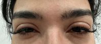 “생리통 약 먹었다가”… 20대 여성, 눈 퉁퉁 부어오른 모습 보니?