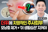[질병백과] 여름 더위에 치명적인 주사피부, 모낭충 제거와 ‘이 습관’ 지키세요